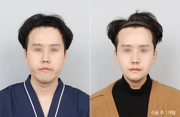 Before/After