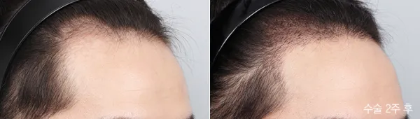 Before/After