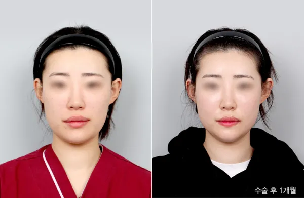 Before/After