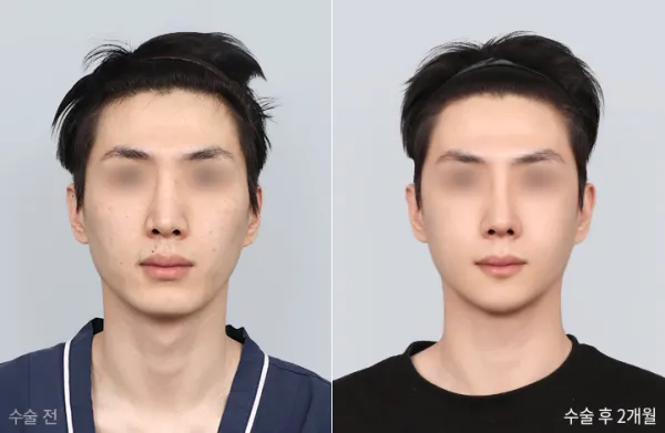 Before/After