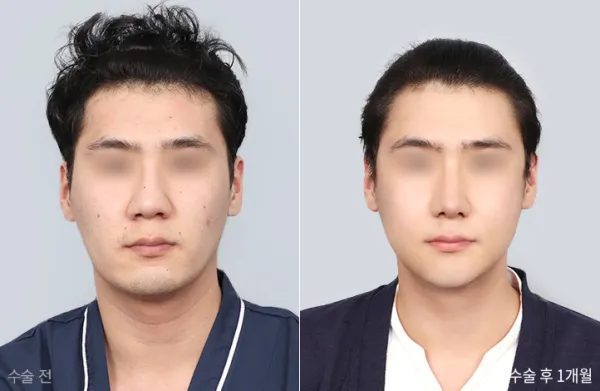 Before/After