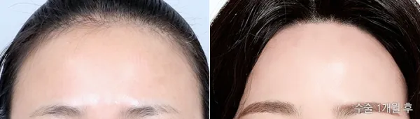 Before/After