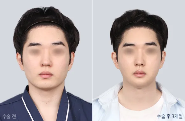 Before/After