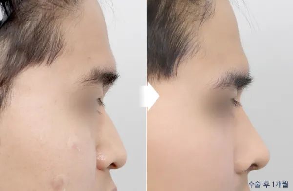 Before/After