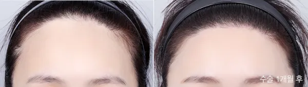 Before/After