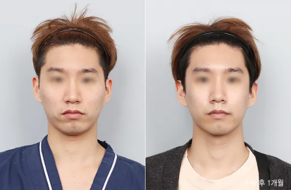 Before/After