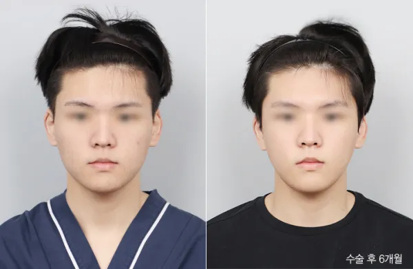 Before/After