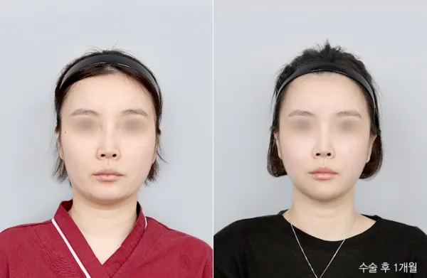 Before/After