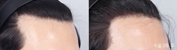 Before/After