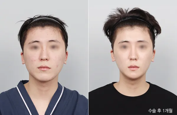 Before/After