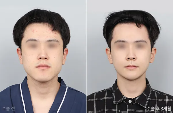 Before/After