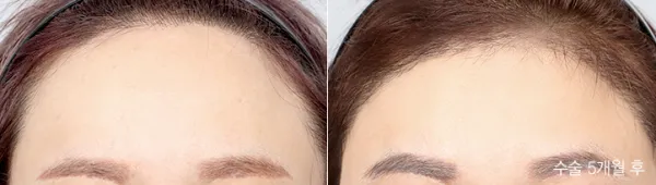 Before/After