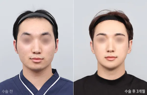 Before/After