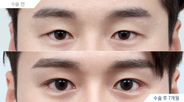 Before/After