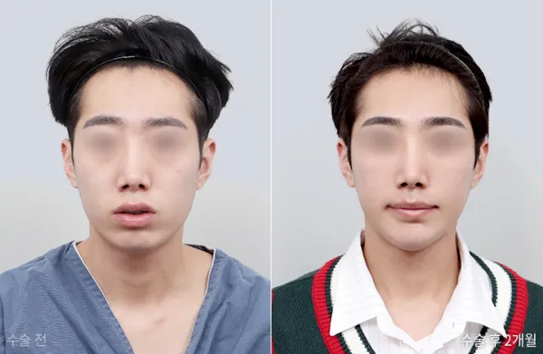 Before/After