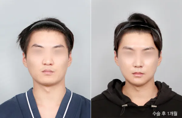Before/After