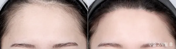 Before/After