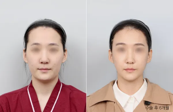 Before/After