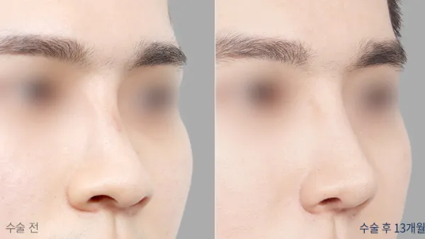Before/After