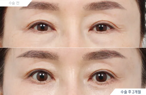 Before/After