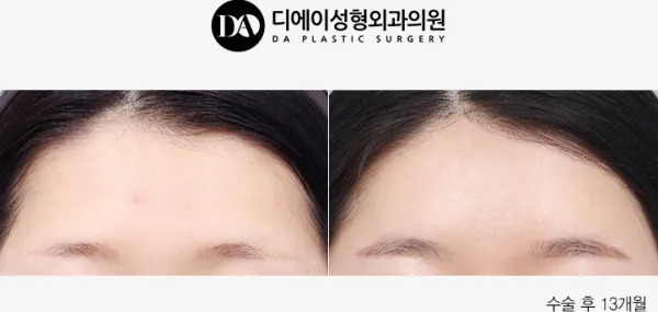 Before/After