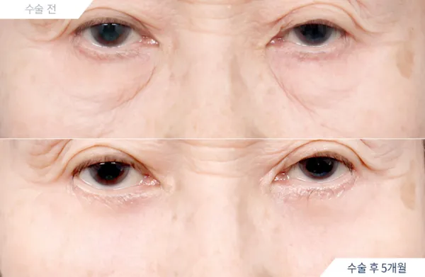 Before/After