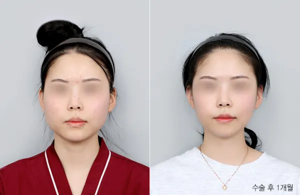 Before/After