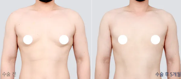 Before/After