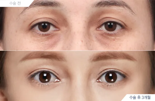 Before/After