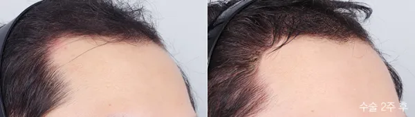 Before/After