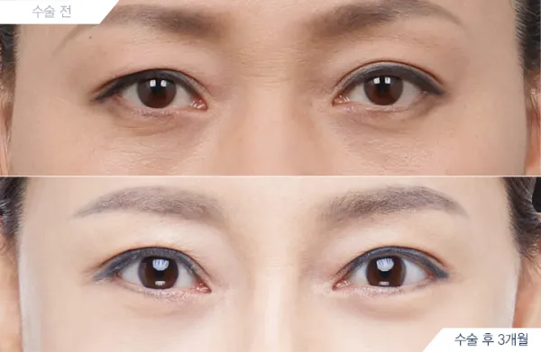 Before/After