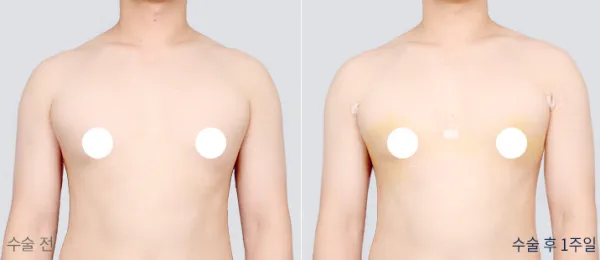 Before/After