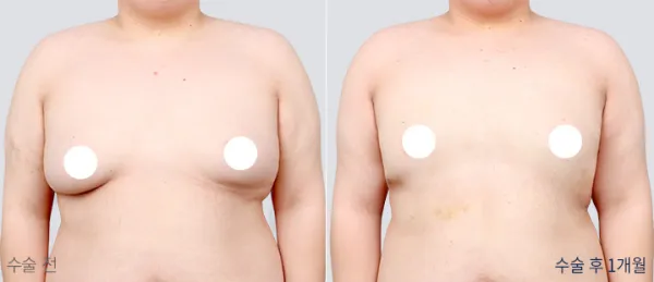Before/After