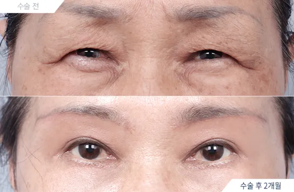 Before/After