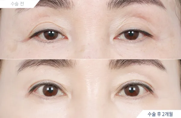 Before/After