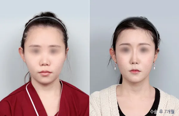 Before/After