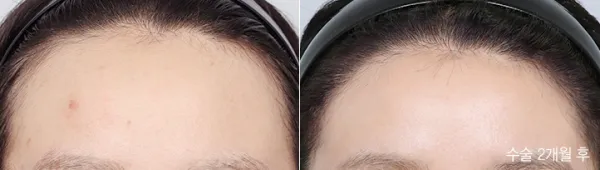 Before/After
