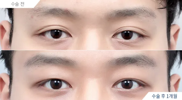Before/After