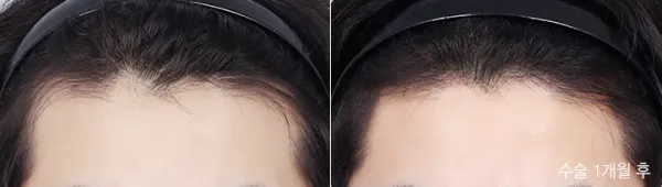 Before/After