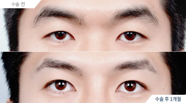 Before/After
