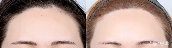 Before/After