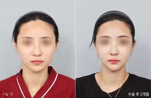 Before/After