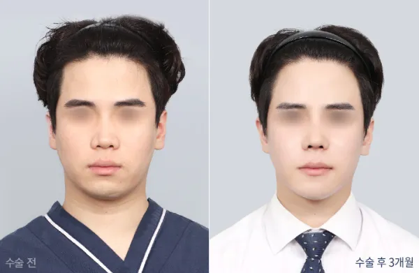 Before/After