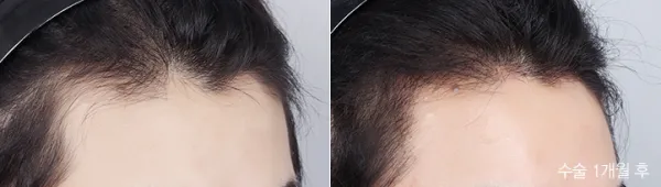 Before/After