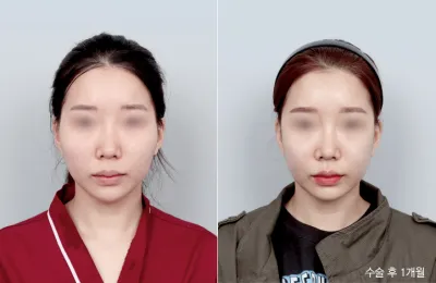 Before & After