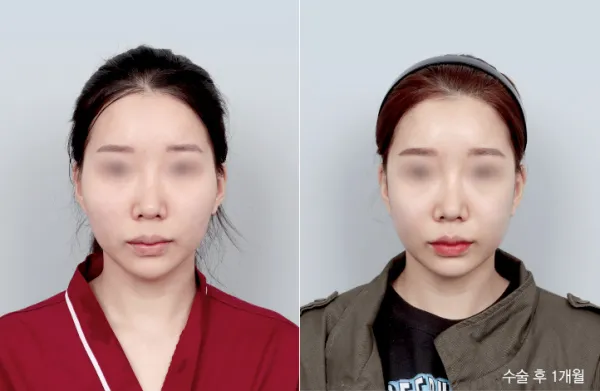 Before/After