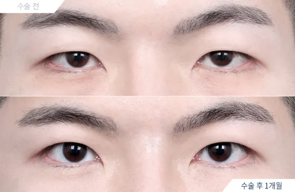 Before/After