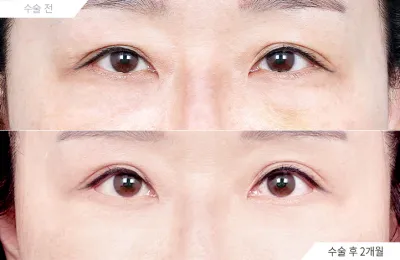 Before & After