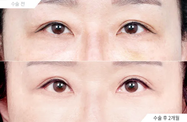 Before/After
