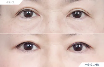 Before & After